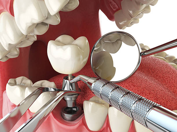 Best Emergency Treatment for Toothache in Belvedere, SC